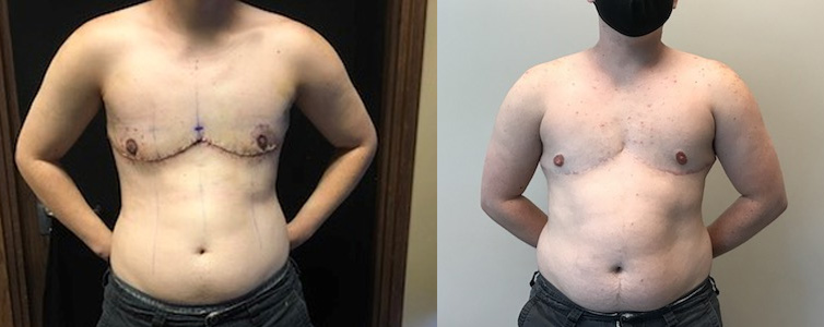 Earlier stage of chest healing after top surgery